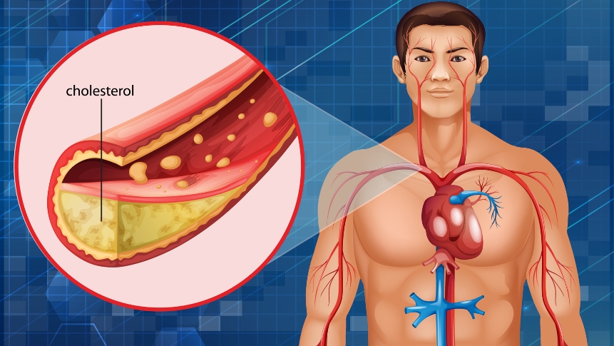 cholesterol plaque buildup in arteries diagram