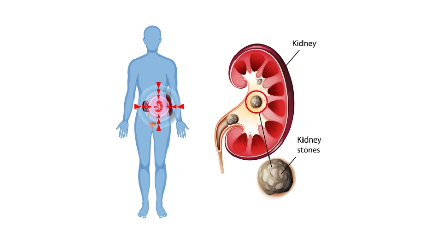 Cycle of recurrent urinary tract infections and kidney stones
