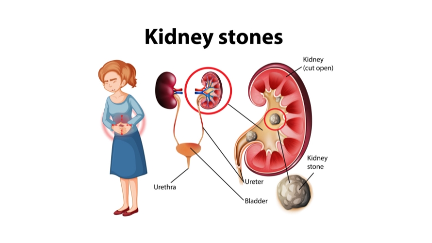 Connection between urinary tract infection and kidney stones