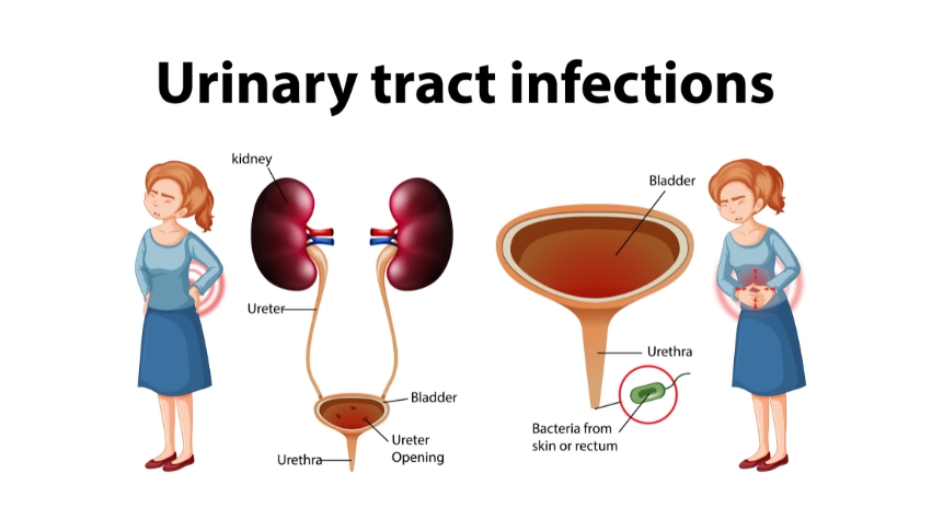 Difference between UTI and kidney stones symptoms