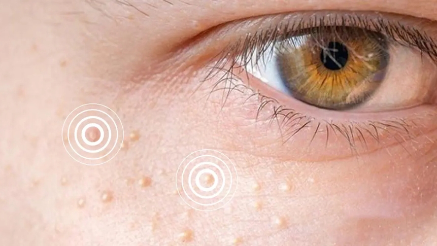 xanthelasma cholesterol deposits eyelids