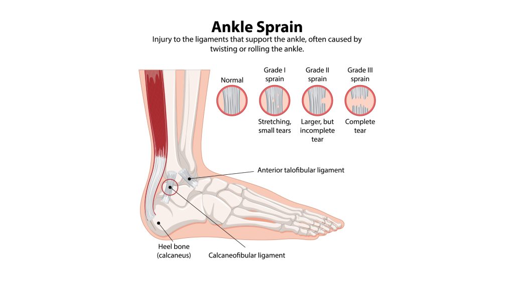 ankle ligament tear diagram showing sprain and injury types
