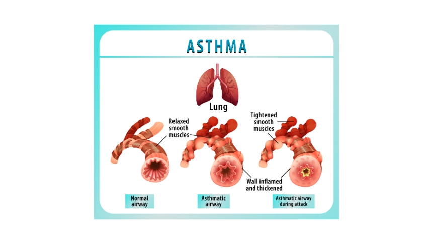 Asthma action plan zones green yellow red