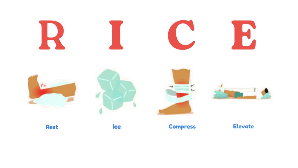 RICE method for ankle sprain treatment rest ice compression elevation